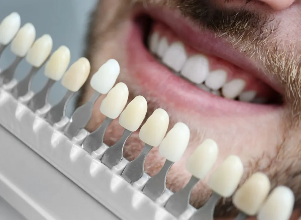 come mantenere le faccette dentali a lungo