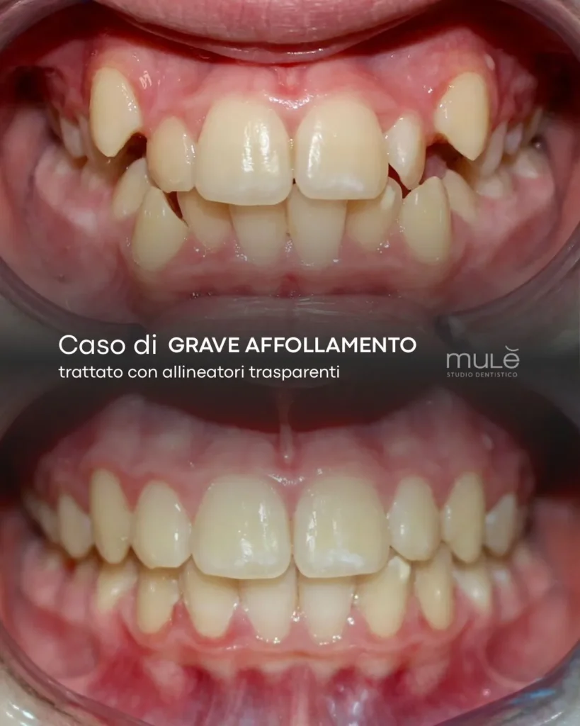 Ortodonzia trasparente caso 3