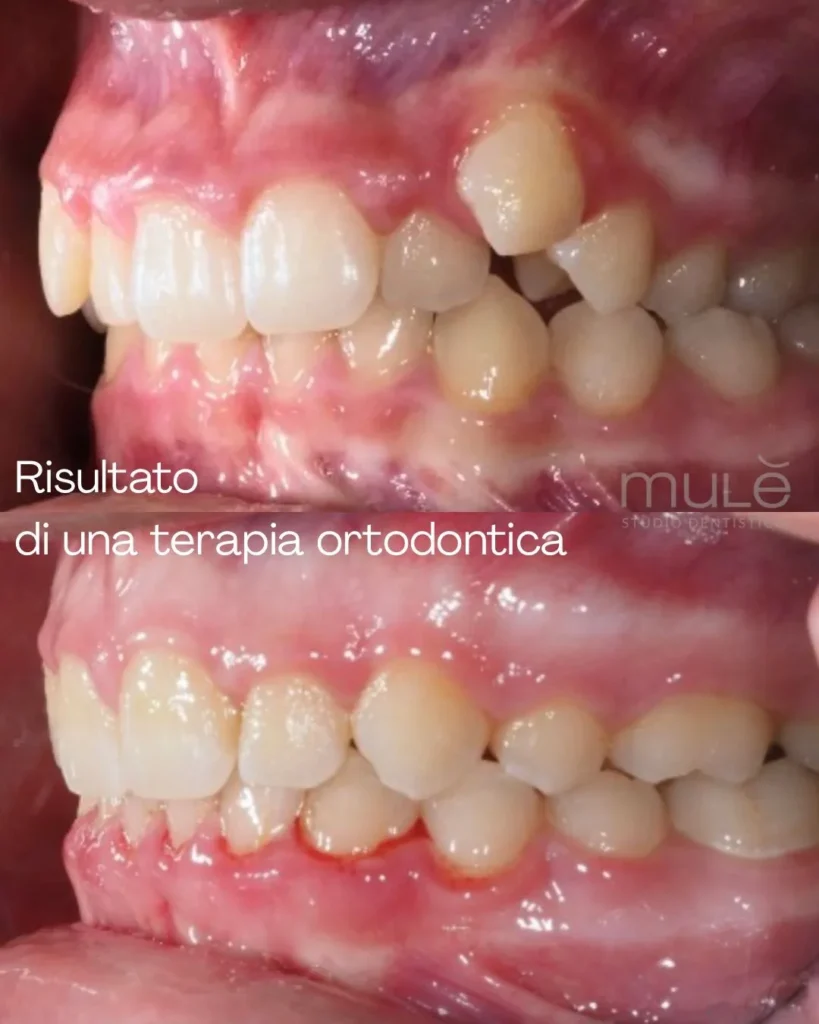 Ortodonzia trasparente caso 4