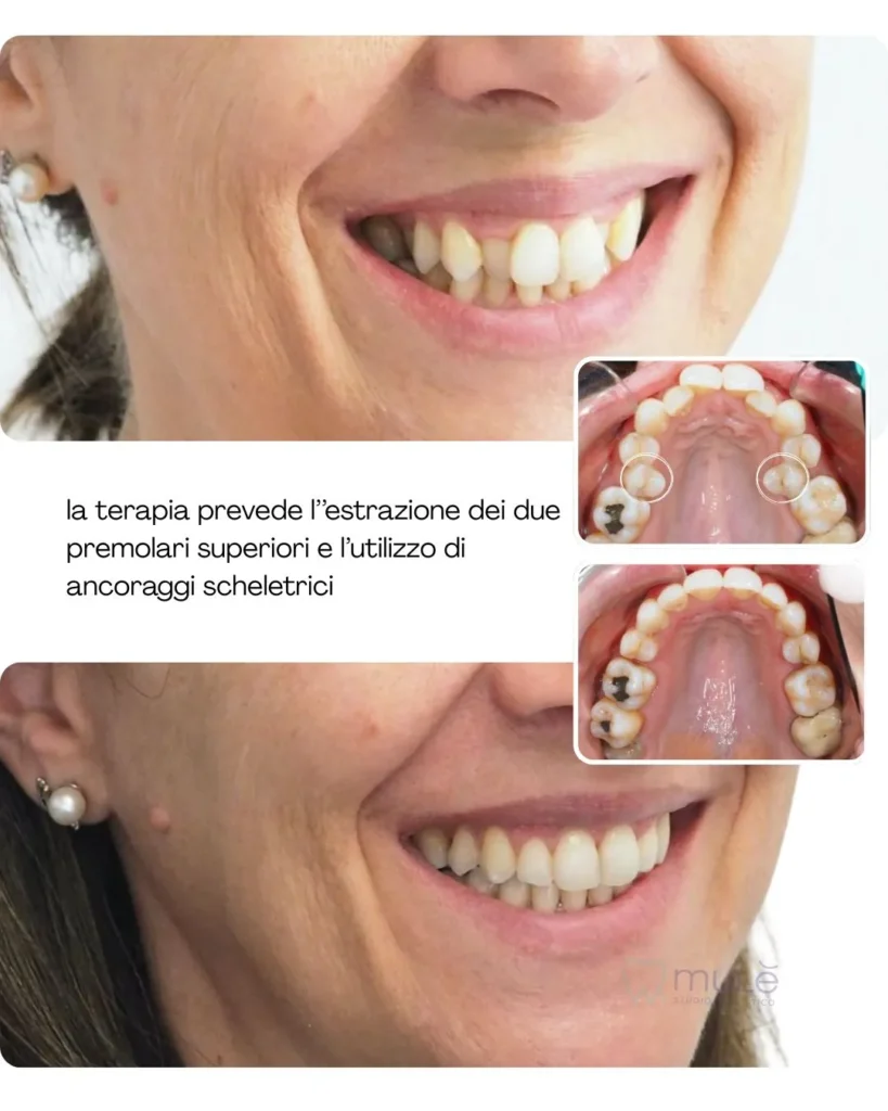 Ortodonzia trasparente caso 6