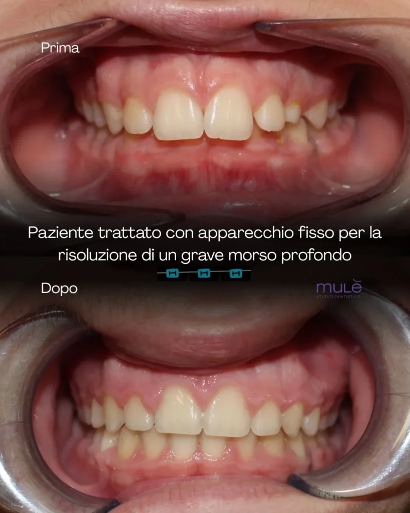 apparecchio fisso caso 1