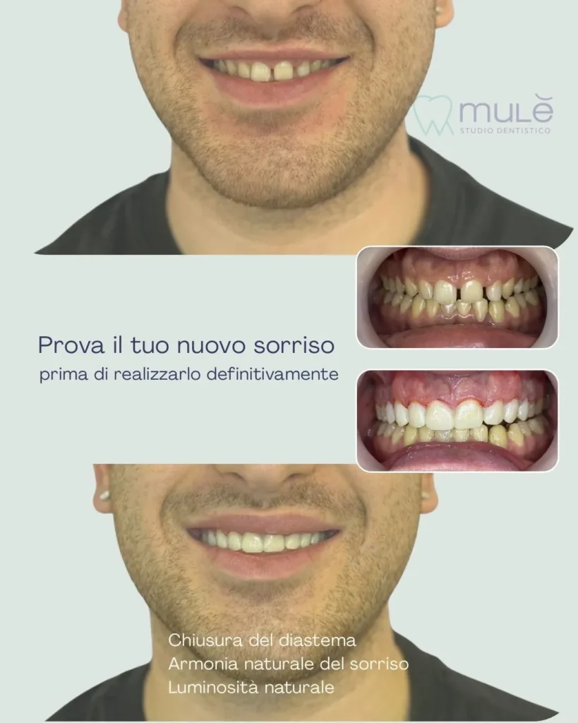 faccette dentali Caso 3 social