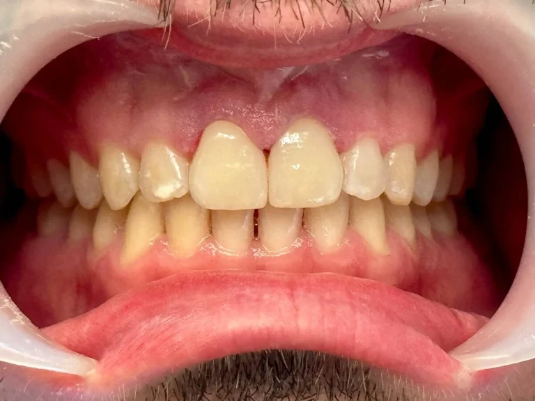 faccette dentali - Caso 4 dopo