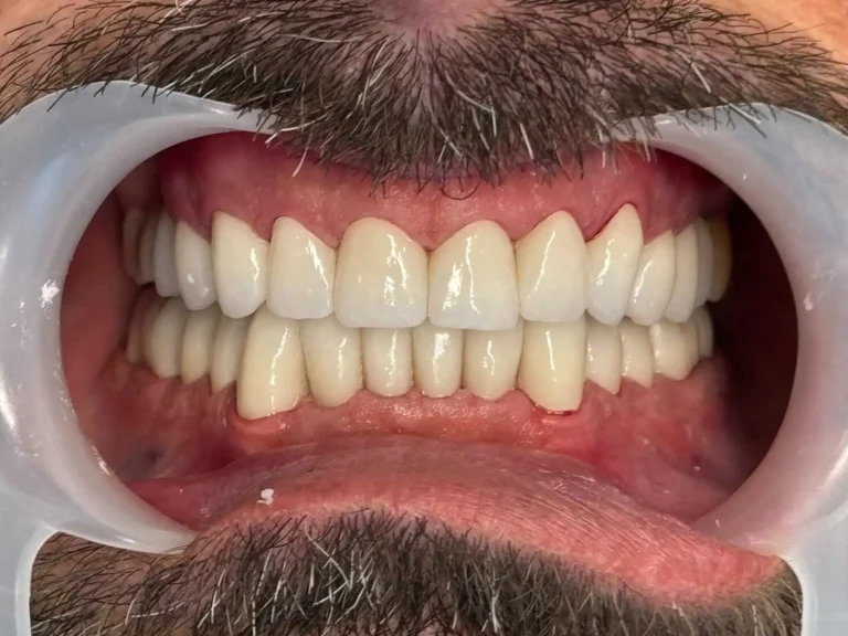 faccette dentali - caso 2 dopo