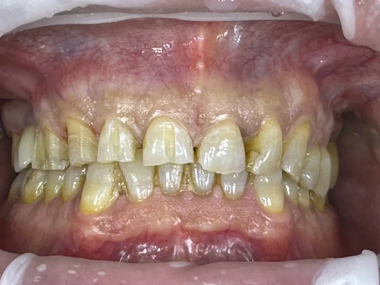 faccette dentali - caso 2 prima