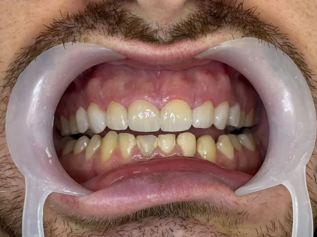 faccette dentali caso 3 dopo 1