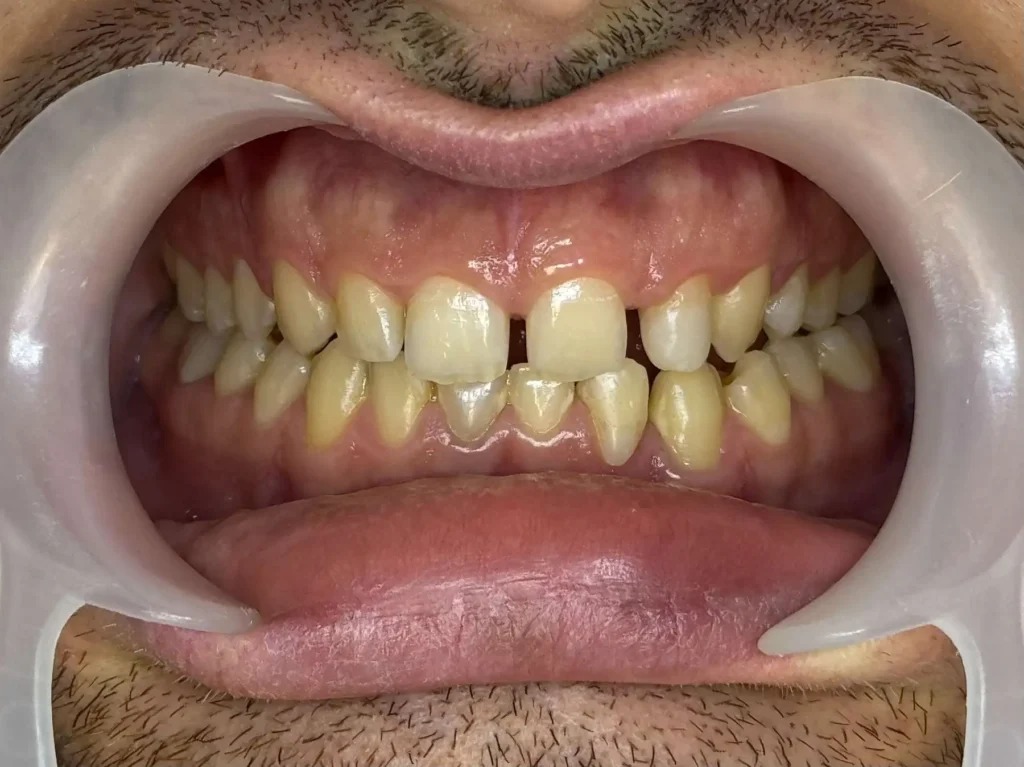 faccette dentali caso 3 prima